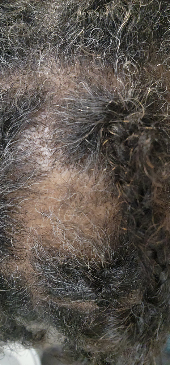 Female Thinning Hair and Balding